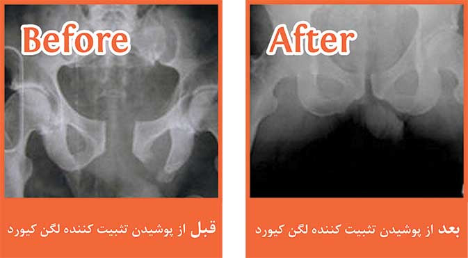 تثبیت کننده آنی لگن بعد از ترما(T-POD)