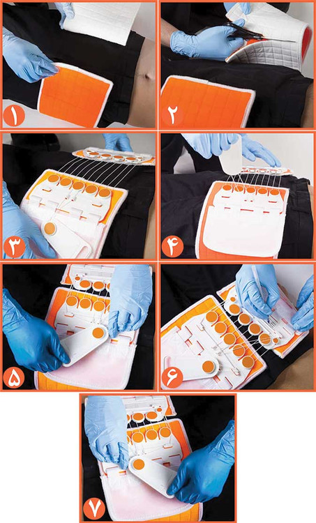 تثبیت کننده آنی لگن بعد از ترما(T-POD)